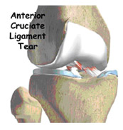 diagnosis,acl injury,acl reconstruction india,acl reconstruction best india,acl reconstructionbest doctors in india,acl reconstruction best surgeon in india,acl reconstructionbest surgery in india,acl reconstruction best treatment in  india,acl reconstruction in south  india,acl reconstruction north  india,acl reconstruction  east india,acl reconstruction west india,acl reconstruction best in  india,acl reconstruction best surgery in india,acl reconstruction cost-effective in  india,acl reconstruction best doctors in india,acl reconstruction india,acl reconstruction india,acl reconstruction india,acl reconstruction now in india,acl reconstruction india,acl reconstruction by dr.bajaj,acl reconstruction by p.s.bajaj