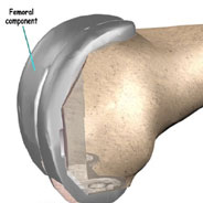 femoral component,knee replacement india,south delhi ,knee replacement india,knee replacement in india,knee replacement in south delhi,knee replacement, knee replacement in delhi,knee replacement surgeon india,knee replacement clinic india,knee replacement doctor india,knee replacement doctor delhi,knee replacement surgeon in south-ex delhi,knee replacement in east delhi, knee replacement, knee replacement india ,knee replacement delhi , knee replacement ,knee replacement india, knee replacement south delhi, knee replacement,knee replacement delhi,knee replacment india
