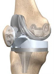 final picture of knee replacement,knee replacement india,south delhi ,knee replacement india,knee replacement in india,knee replacement in south delhi,knee replacement, knee replacement in delhi,knee replacement surgeon india,knee replacement clinic india,knee replacement doctor india,knee replacement doctor delhi,knee replacement surgeon in south-ex delhi,knee replacement in east delhi, knee replacement, knee replacement india ,knee replacement delhi , knee replacement ,knee replacement india, knee replacement south delhi, knee replacement
