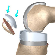 patella implants,knee replacement india,south delhi ,knee replacement india,knee replacement in india,knee replacement in south delhi,knee replacement, knee replacement in delhi,knee replacement surgeon india,knee replacement clinic india,knee replacement doctor india,knee replacement doctor delhi,knee replacement surgeon in south-ex delhi,knee replacement in east delhi, knee replacement, knee replacement india ,knee replacement delhi , knee replacement ,knee replacement india, knee replacement south delhi, knee replacement,knee replacement india