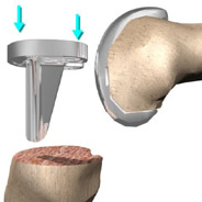 tibia tray,knee replacement india,south delhi ,knee replacement india,knee replacement in india,knee replacement in south delhi,knee replacement, knee replacement in delhi,knee replacement surgeon india,knee replacement clinic india,knee replacement doctor india,knee replacement doctor delhi,knee replacement surgeon in south-ex delhi,knee replacement in east delhi, knee replacement, knee replacement india ,knee replacement delhi , knee replacement ,knee replacement india, knee replacement south delhi, knee replacement,knee replacement india,south delhi ,knee replacement india,knee replacement in india,knee replacement in south delhi,knee replacement, knee replacement in delhi,knee replacement surgeon india,knee replacement clinic india,knee replacement doctor india,knee replacement doctor delhi,knee replacement surgeon in south-ex delhi,knee replacement in east delhi, knee replacement, knee replacement india ,knee replacement delhi , knee replacement ,knee replacement india, knee replacement south delhi