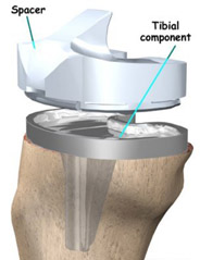 tibial components,knee replacement india,south delhi ,knee replacement india,knee replacement in india,knee replacement in south delhi,knee replacement, knee replacement in delhi,knee replacement surgeon india,knee replacement clinic india,knee replacement doctor india,knee replacement doctor delhi,knee replacement surgeon in south-ex delhi,knee replacement in east delhi, knee replacement, knee replacement india ,knee replacement delhi , knee replacement ,knee replacement india, knee replacement south delhi, knee replacement,knee replacement india,knee replacement delhi