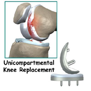 unicompartmental knee replacement,knee replacement india,south delhi ,knee replacement india,knee replacement in india,knee replacement in south delhi,knee replacement, knee replacement in delhi,knee replacement surgeon india,knee replacement clinic india,knee replacement doctor india,knee replacement doctor delhi,knee replacement surgeon in south-ex delhi,knee replacement in east delhi, knee replacement, knee replacement india ,knee replacement delhi , knee replacement ,knee replacement india, knee replacement south delhi, knee replacement