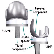components,knee replacement, knee replacement surgeon, knee replacement surgeon in india, knee replacement surgeon in delhi, knee replacement, knee replacement, knee replacement clinic,knee replacement best in india,knee replacement best in delhi,knee replacement in south delhi,knee replacement best surgeon in india,knee replacement best surgery in india ,knee replacement best in india,knee replacement in india,knee replacement best in delhi,knee replacement delhi,knee replacement india