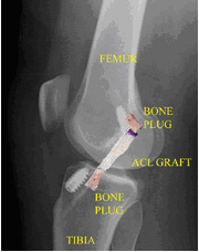 femur,surgical procedure,acl injury,acl reconstruction india,acl reconstruction best india,acl reconstructionbest doctors in india,acl reconstruction best surgeon in india,acl reconstructionbest surgery in india,acl reconstruction best treatment in  india,acl reconstruction in south  india,acl reconstruction north  india,acl reconstruction  east india,acl reconstruction west india,acl reconstruction best in  india,acl reconstruction best surgery in india,acl reconstruction cost-effective in  india,acl reconstruction best doctors in india,acl reconstruction india,acl reconstruction india,acl reconstruction india,acl reconstruction now in india,acl reconstruction india,acl reconstruction by dr.bajaj,acl reconstruction by p.s.bajaj