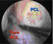 torn acl,acl injury,acl reconstruction india,acl reconstruction best india,acl reconstructionbest doctors in india,acl reconstruction best surgeon in india,acl reconstructionbest surgery in india,acl reconstruction best treatment in  india,acl reconstruction in south  india,acl reconstruction north  india,acl reconstruction  east india,acl reconstruction west india,acl reconstruction best in  india,acl reconstruction best surgery in india,acl reconstruction cost-effective in  india,acl reconstruction best doctors in india,acl reconstruction india,acl reconstruction india,acl reconstruction india,acl reconstruction now in india,acl reconstruction india,acl reconstruction by dr.bajaj,acl reconstruction by p.s.bajaj